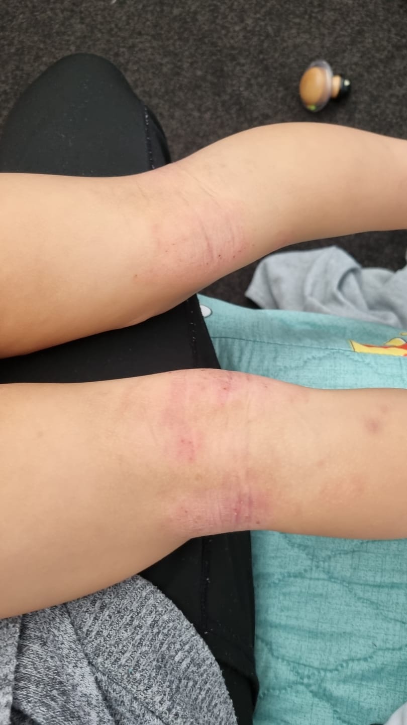 Customer photo review of Kawakawa Repair Balm - Winner, Best SOS/Healing Balm 2024
