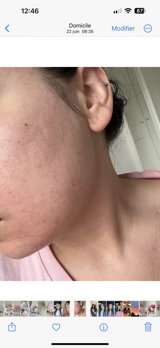 Customer photo review of VT Cosmetics - Sérum Réparateur VT Reedle shot (3 formules)
