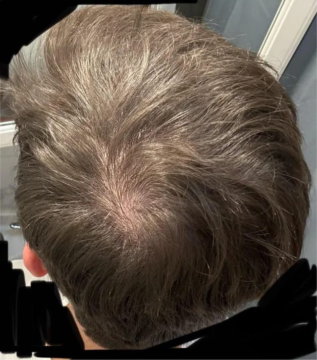 Customer photo review of Volumane Anti-Thinning Stimulating Shampoo