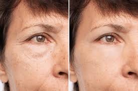 Customer photo review of VOVA™ - Retinolos szemkörnyékápoló & ránctalanító krém