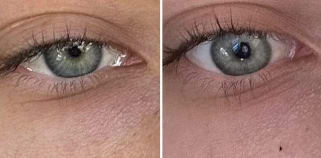 Customer photo review of VOVA™ - Retinolos szemkörnyékápoló & ránctalanító krém