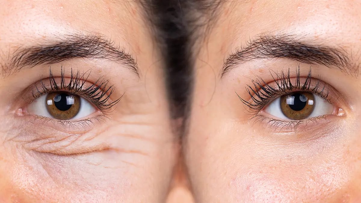 Customer photo review of VOVA™ - Retinolos szemkörnyékápoló & ránctalanító krém