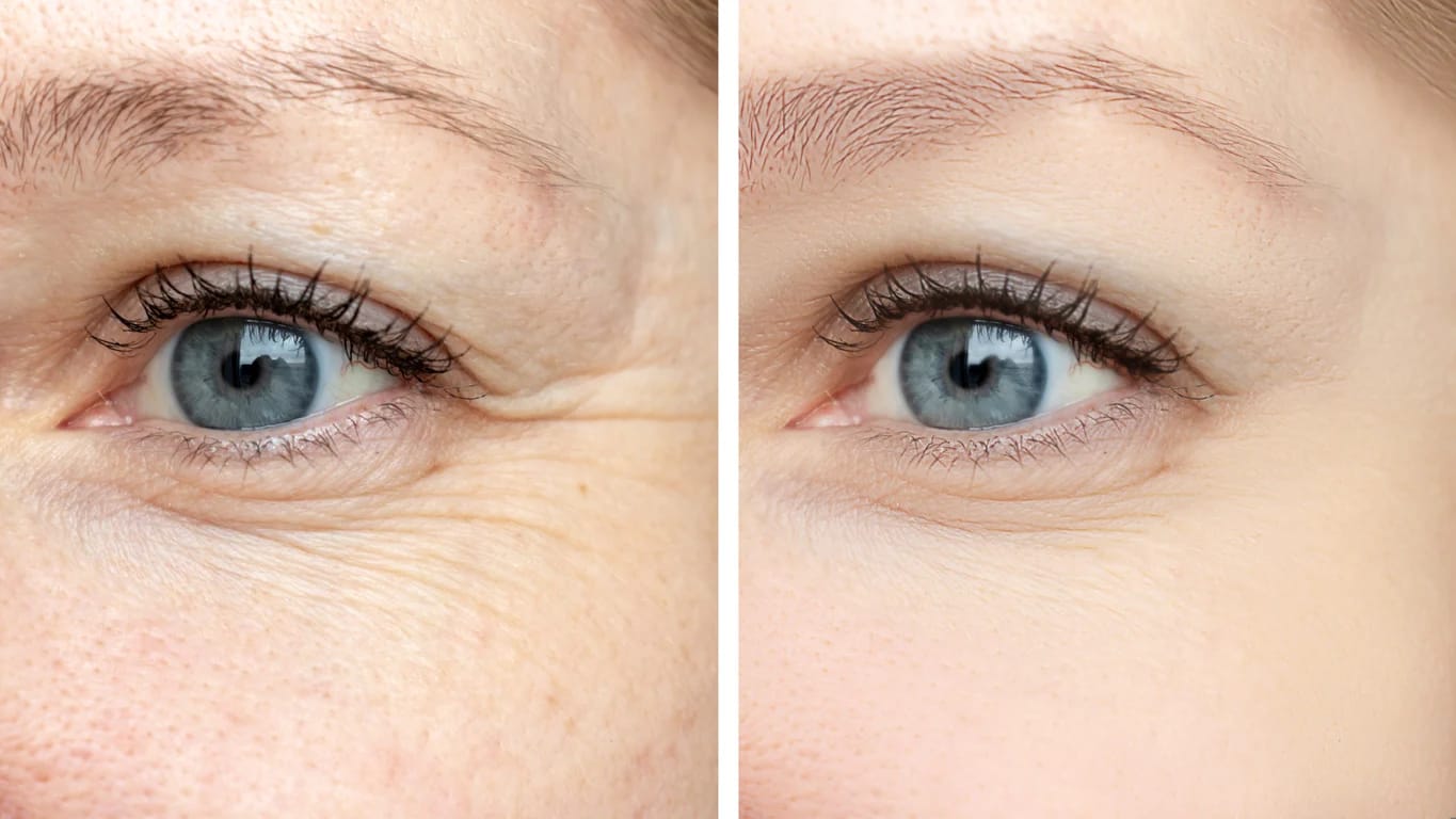 Customer photo review of VOVA™ - Retinolos szemkörnyékápoló & ránctalanító krém