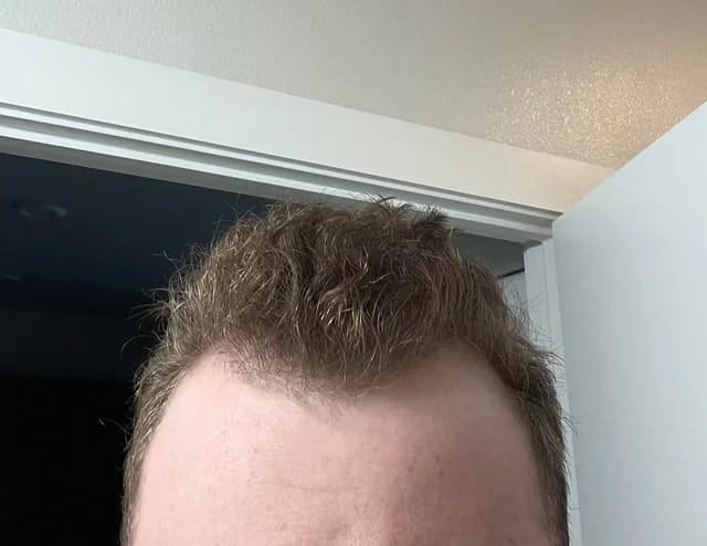 Customer photo review of Volumane Anti-Thinning Stimulating Shampoo