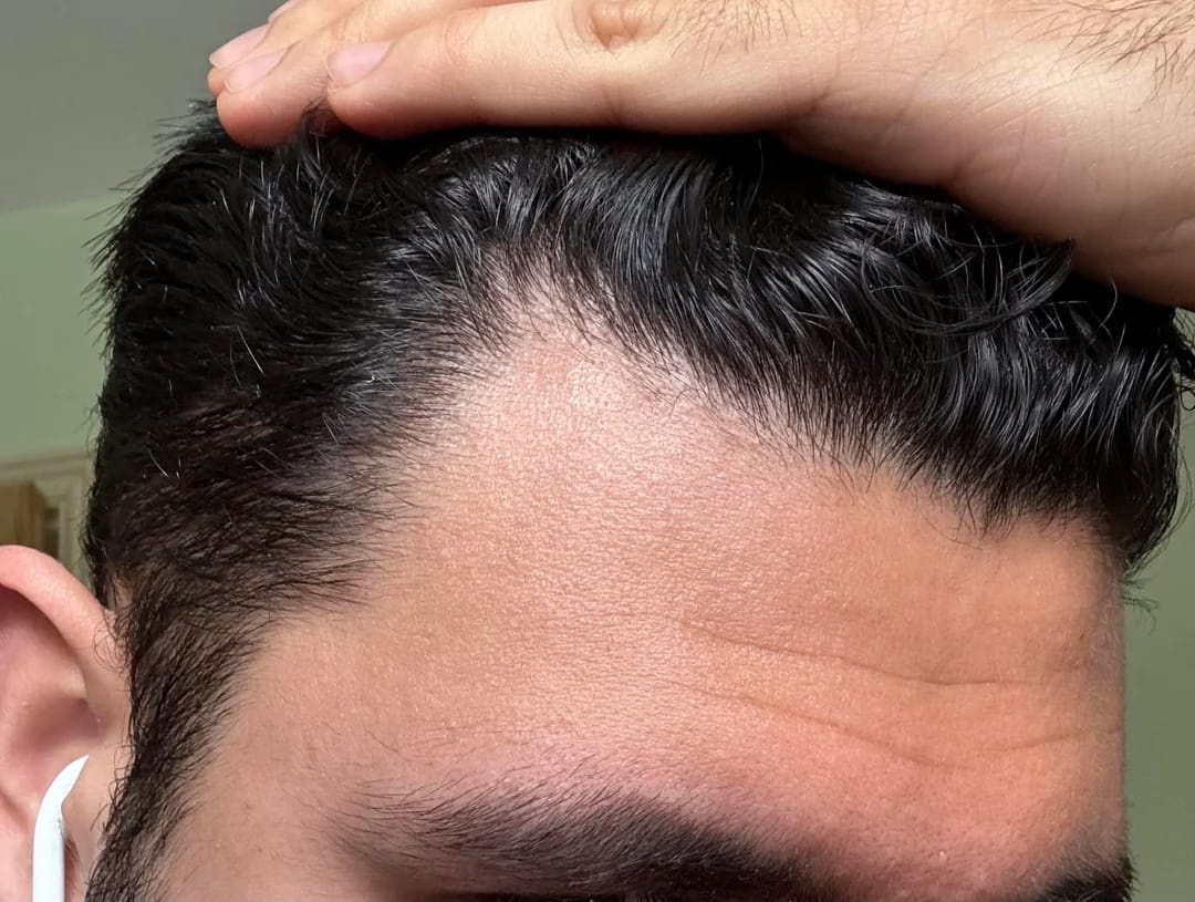 Customer photo review of Volumane Anti-Thinning Stimulating Shampoo