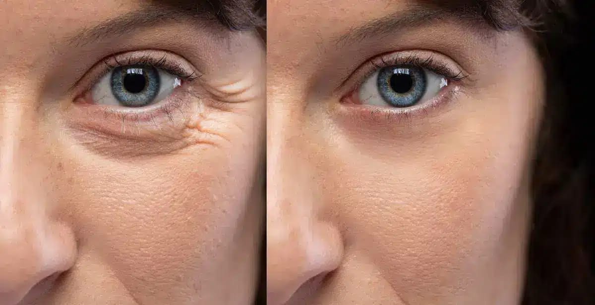 Customer photo review of VOVA™ - Retinolos szemkörnyékápoló & ránctalanító krém