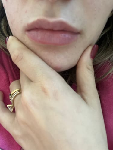Customer photo review of LipFix: Filler