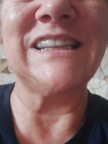 Customer photo review of Custom-fit 3.0mm Soft Upper Night Guard for Teeth Grinding