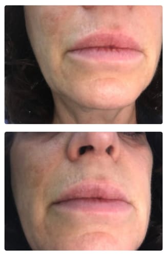 Customer photo review of EvenSkyn® Venus: Premium Eyelid Anti-Aging Device
