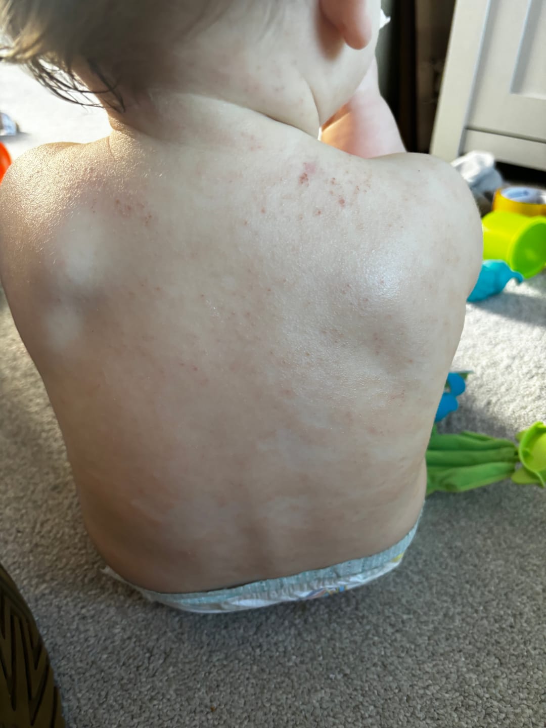 Customer photo review of Bioskin Junior Outbreak Rescue Cream