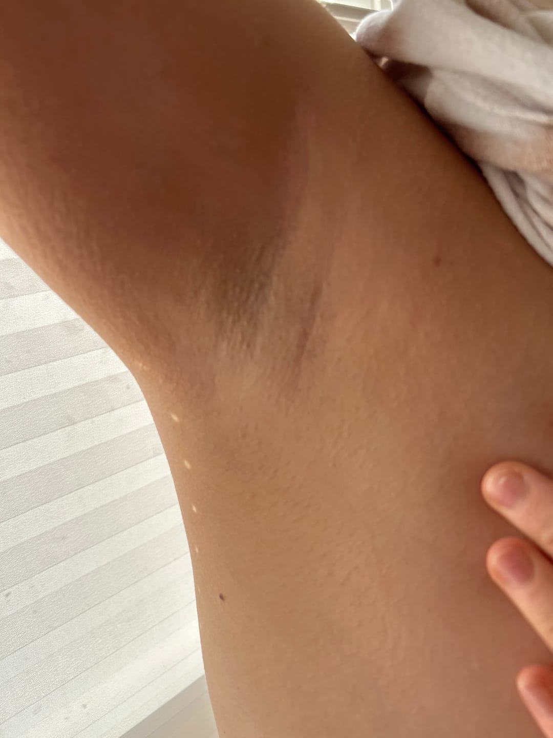 Customer photo review of IPL Max - Permanent Hårfjerner