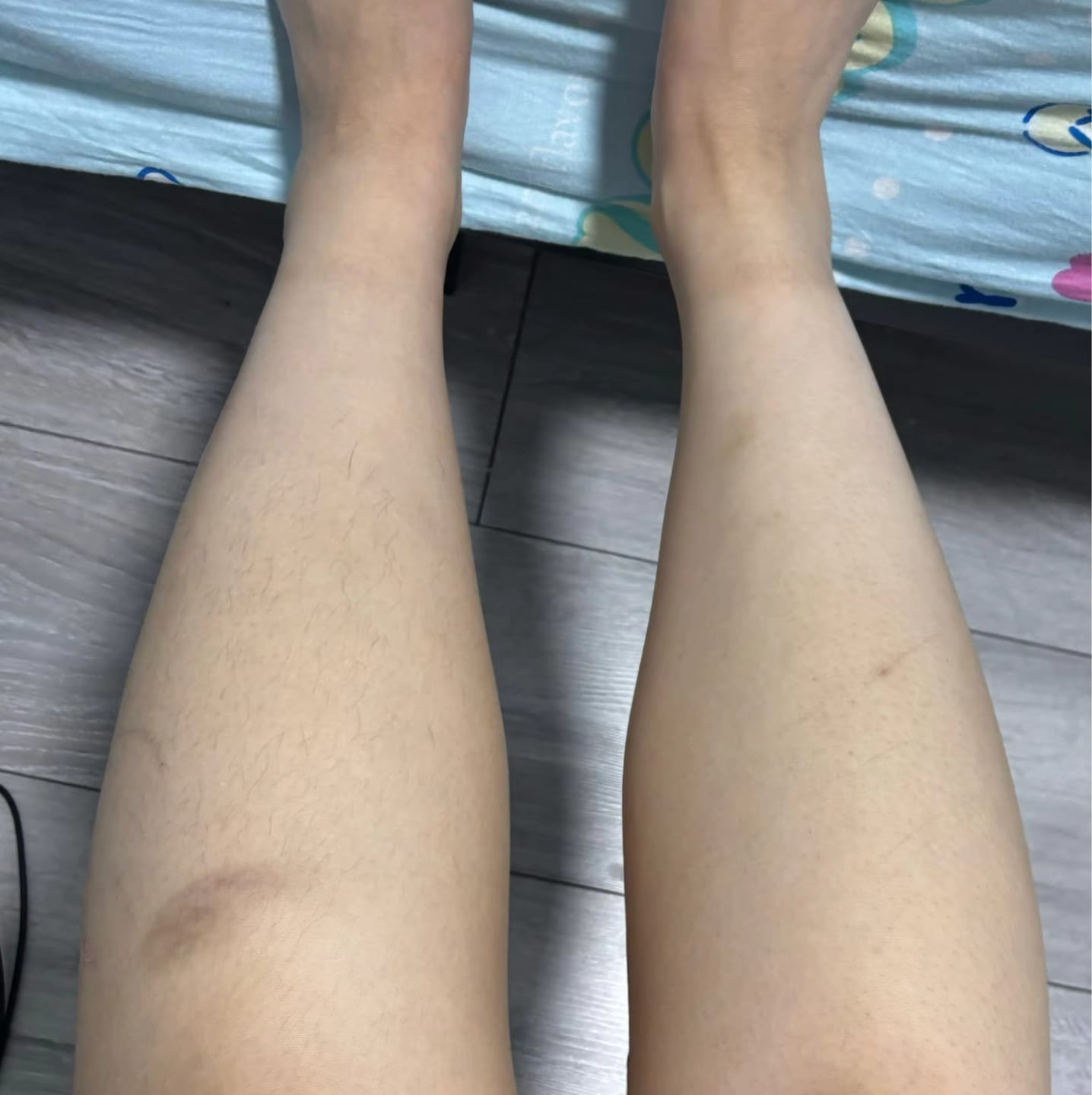 Customer photo review of Lunera IPL Pro
