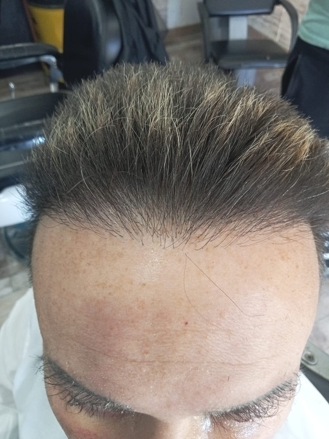 Customer photo review of Fibre copri Calvizie da 27.5gr | Castano Chiaro | 60 Giorni di applicazioni