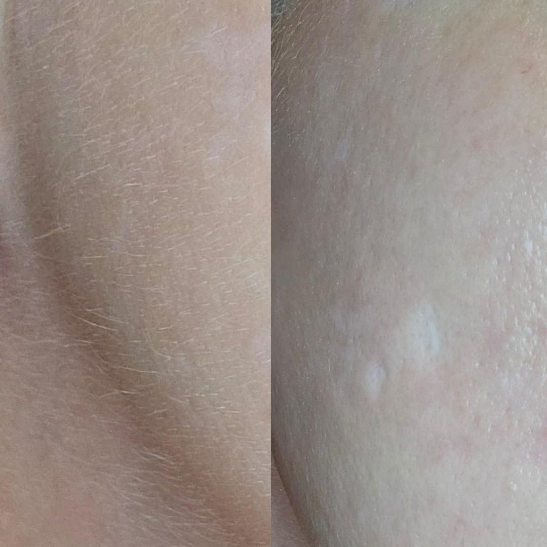 Customer photo review of SkinGlow™ Комплект за Дермапланинг