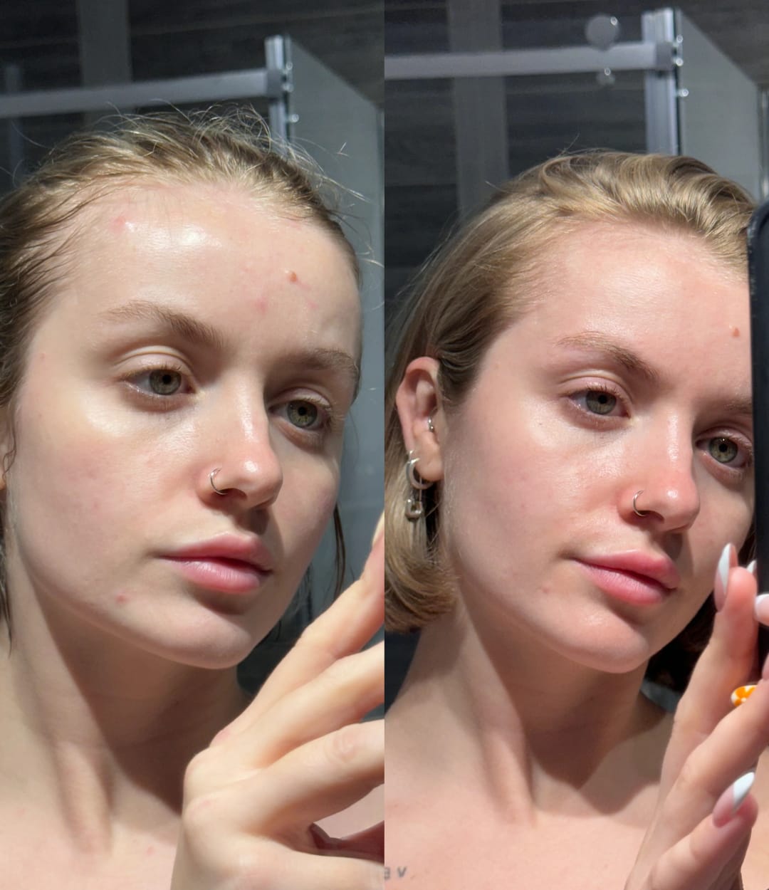 Customer photo review of Pimple Patches with Salicylic Acid - 72 Pink Teddies