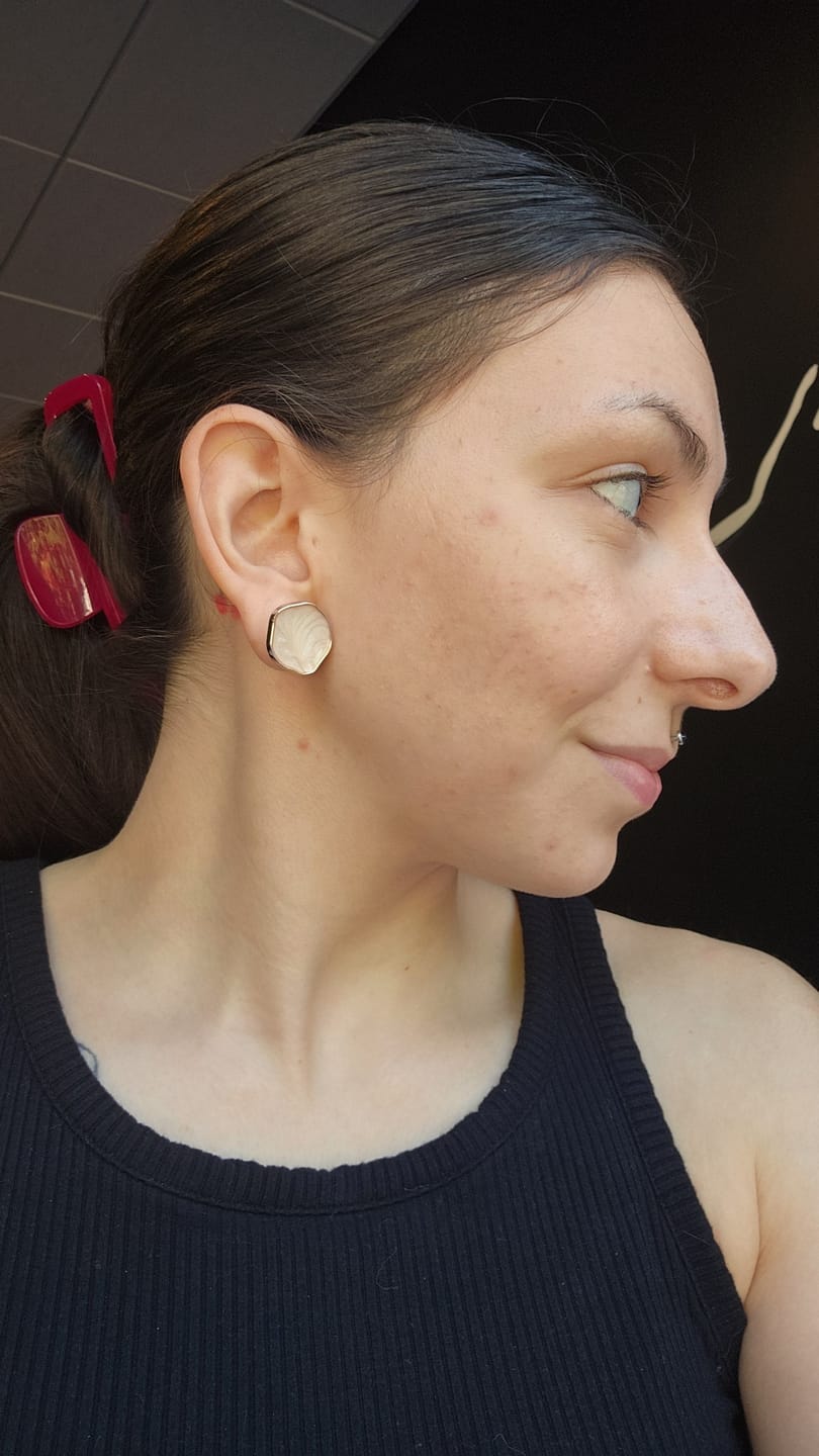 Customer photo review of Pimple Patches with Salicylic Acid - 72 Pink Teddies