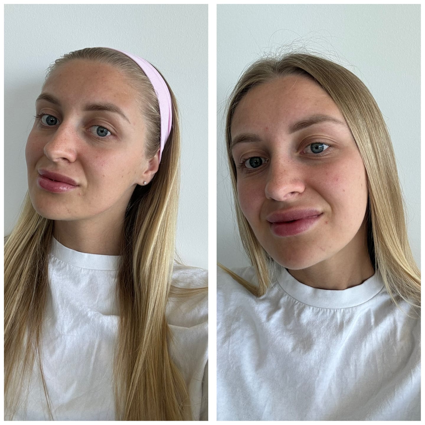 Customer photo review of Pimple Patches with Salicylic Acid - 72 Pink Teddies