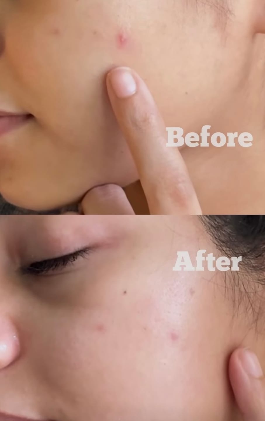 Customer photo review of Pimple Patches with Salicylic Acid - 72 Pink Teddies