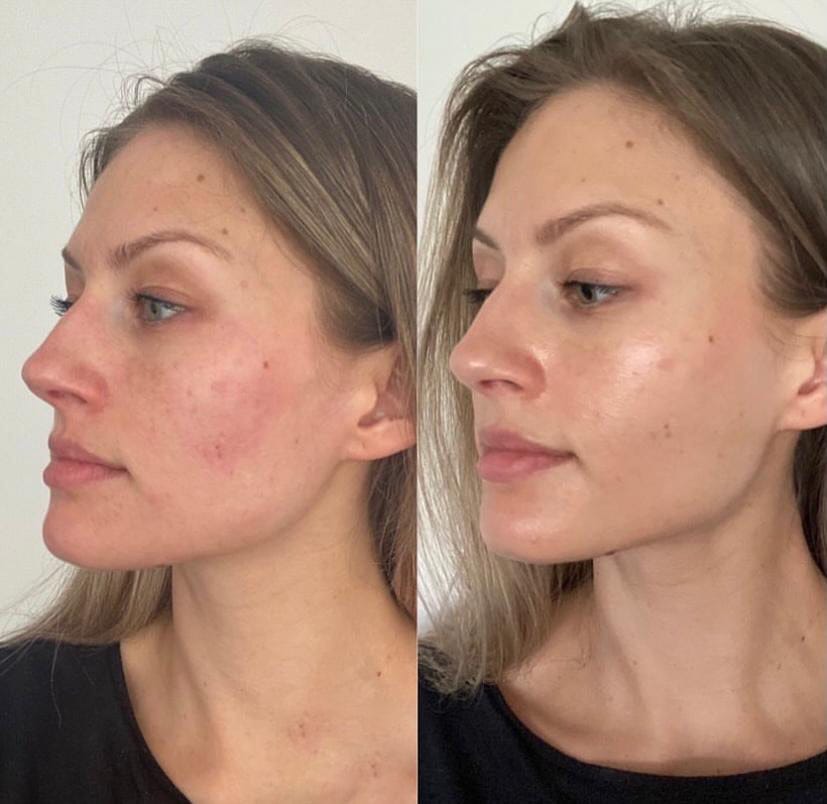 Customer photo review of SkinGlow™ Комплект за Дермапланинг