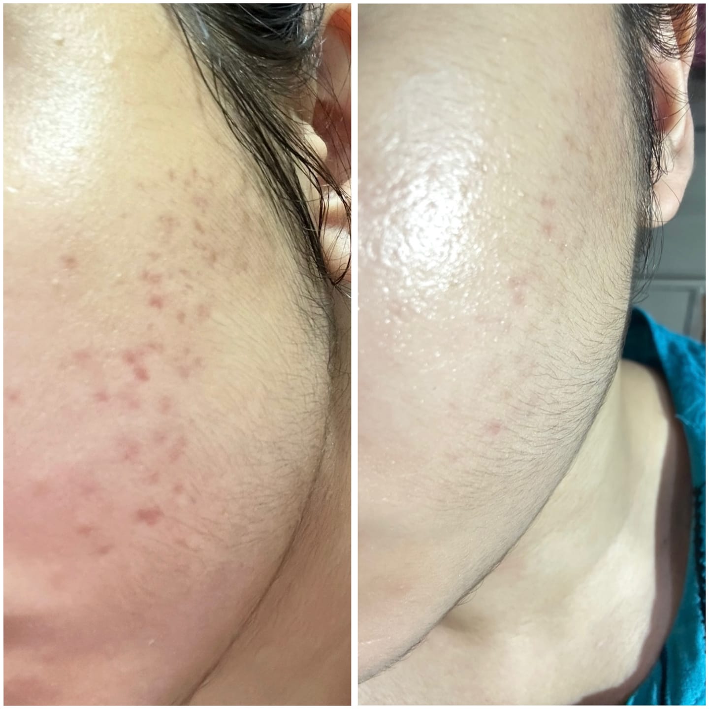 Customer photo review of ACNE CLARIFYING SERUM - Energetic Skin Therapy for Acne & Scars