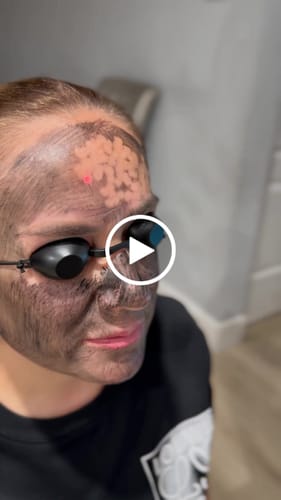 Customer video review of PicoElim Pico Laser Tattoo Removal Machine