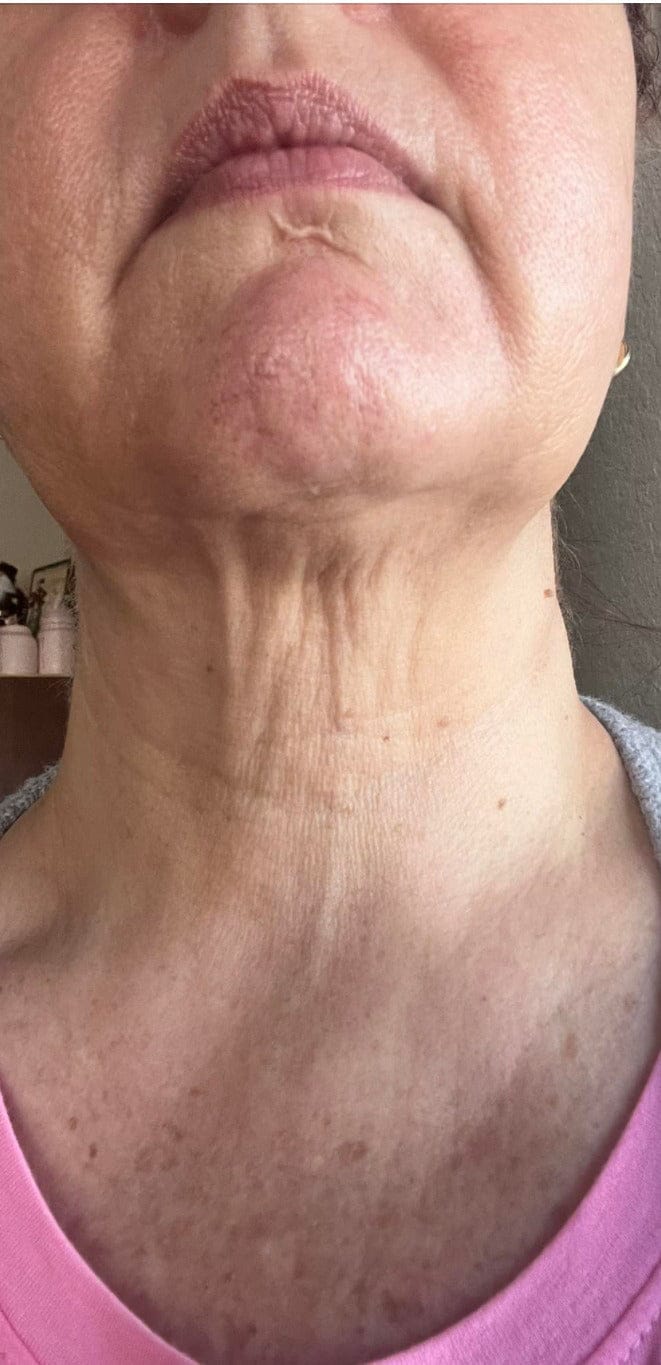 Customer photo review of Seranova Micro Infusion System™