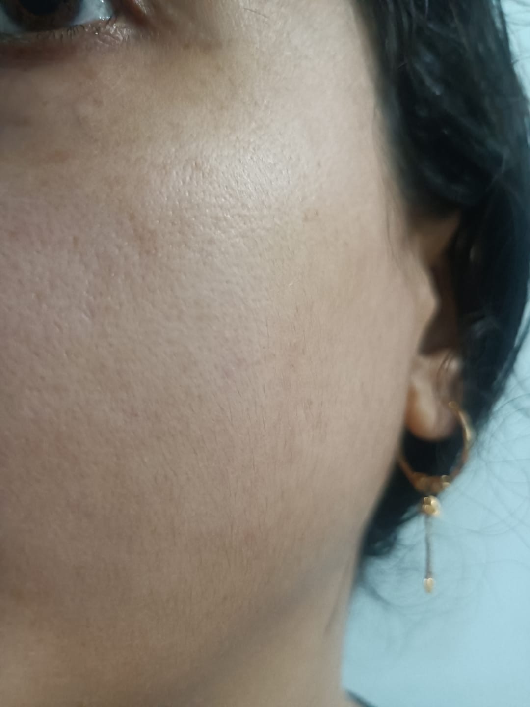 Customer photo review of Melarid De-Pigmenting Serum