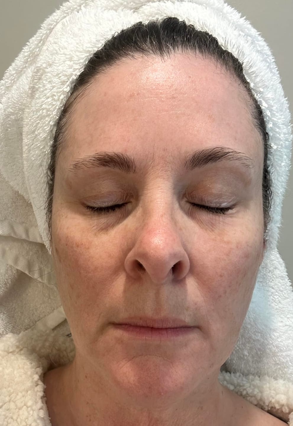 Customer photo review of Seranova Micro Infusion System™