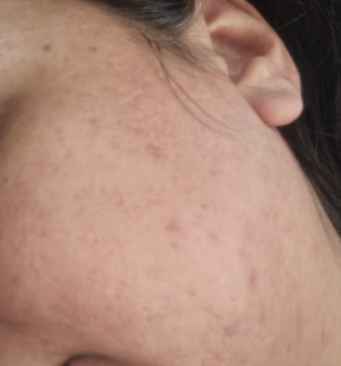 Customer photo review of SPECIAL PIGMENTATION BUNDLE (MELASMA, FRECKLES & DARK SPOTS)