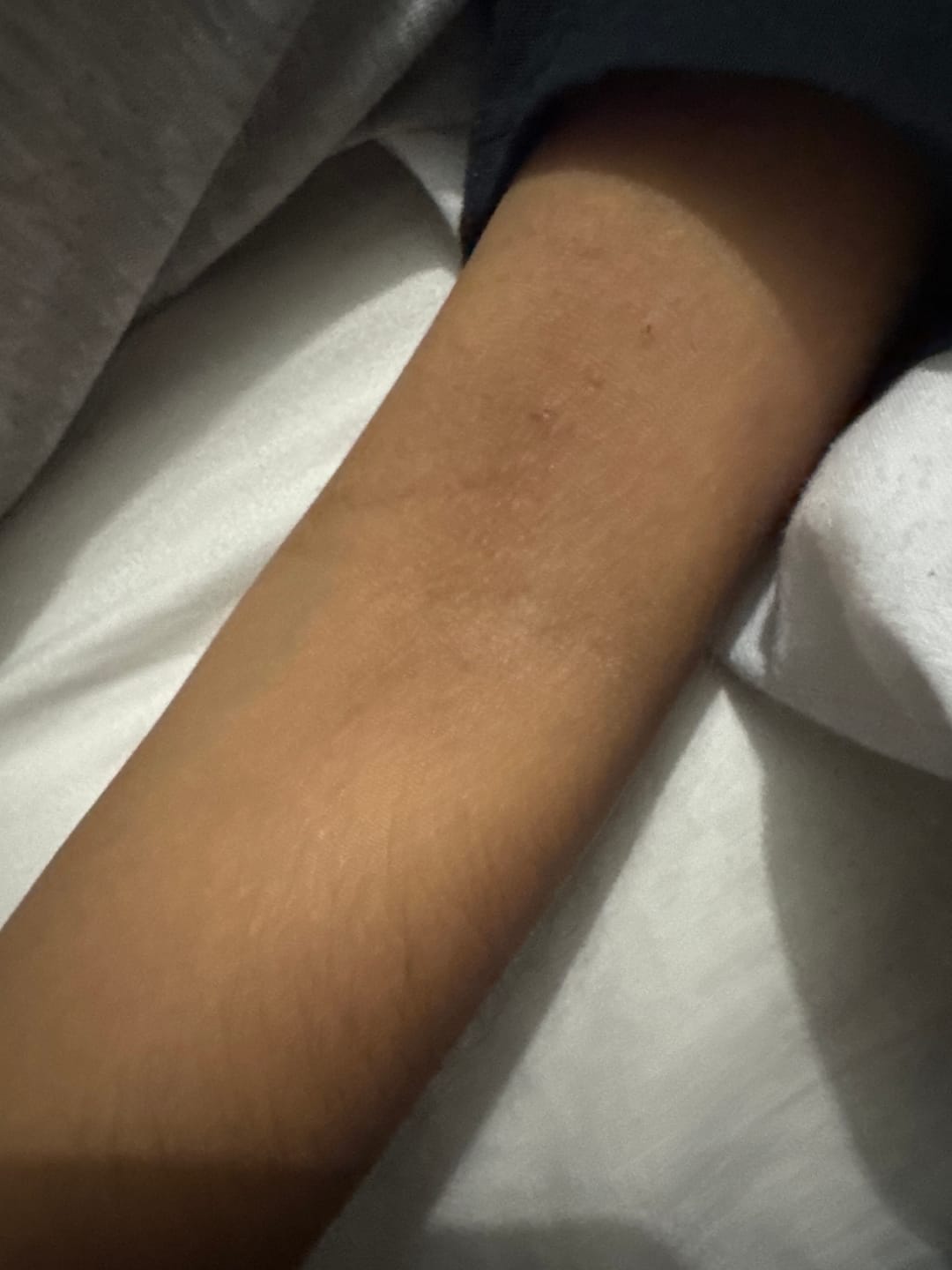 Customer photo review of Bioskin Junior Outbreak Rescue Cream