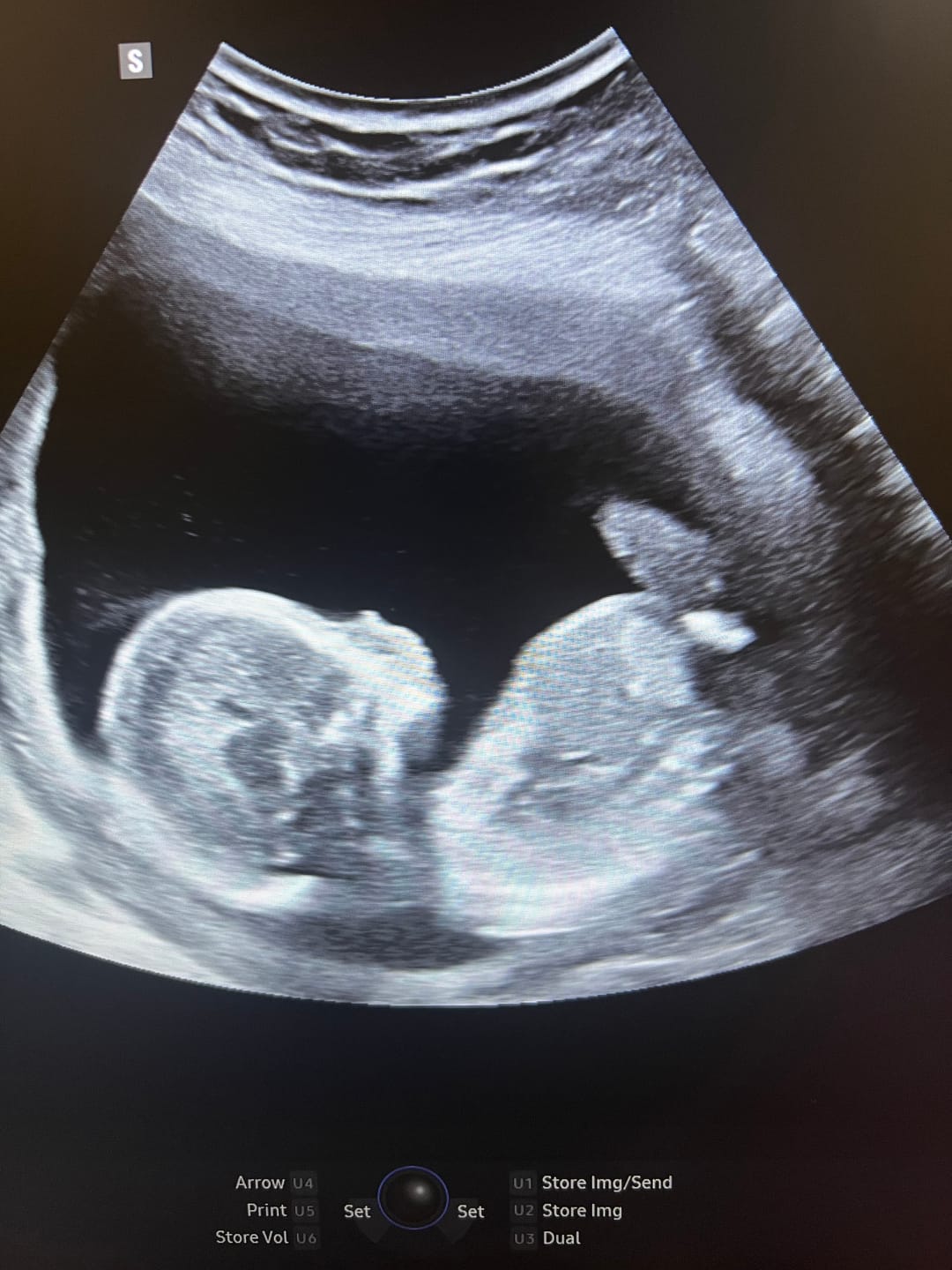 Customer photo review of EarlyReveal Tap DNA Gender Test Over 99% Accurate | Painless & Needle Free | Next Day Results