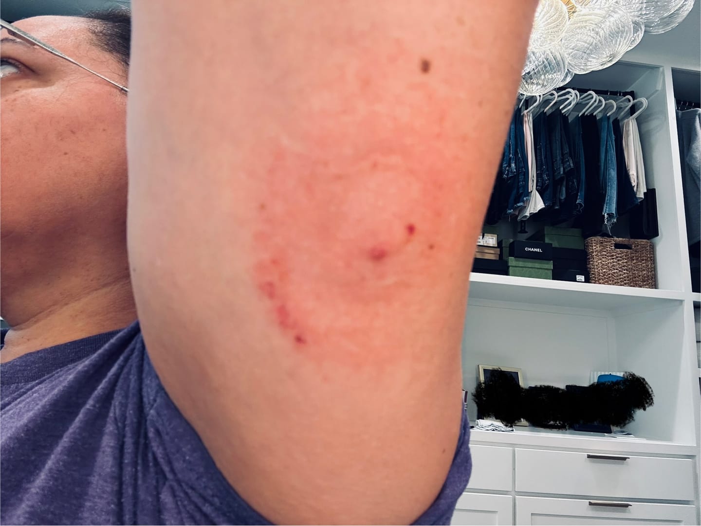 Customer photo review of Skin Grip Original - Dexcom G7 & Stelo Adhesive Patches