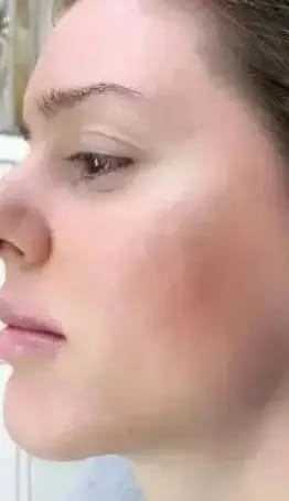 Customer photo review of Young Skin Acne Set