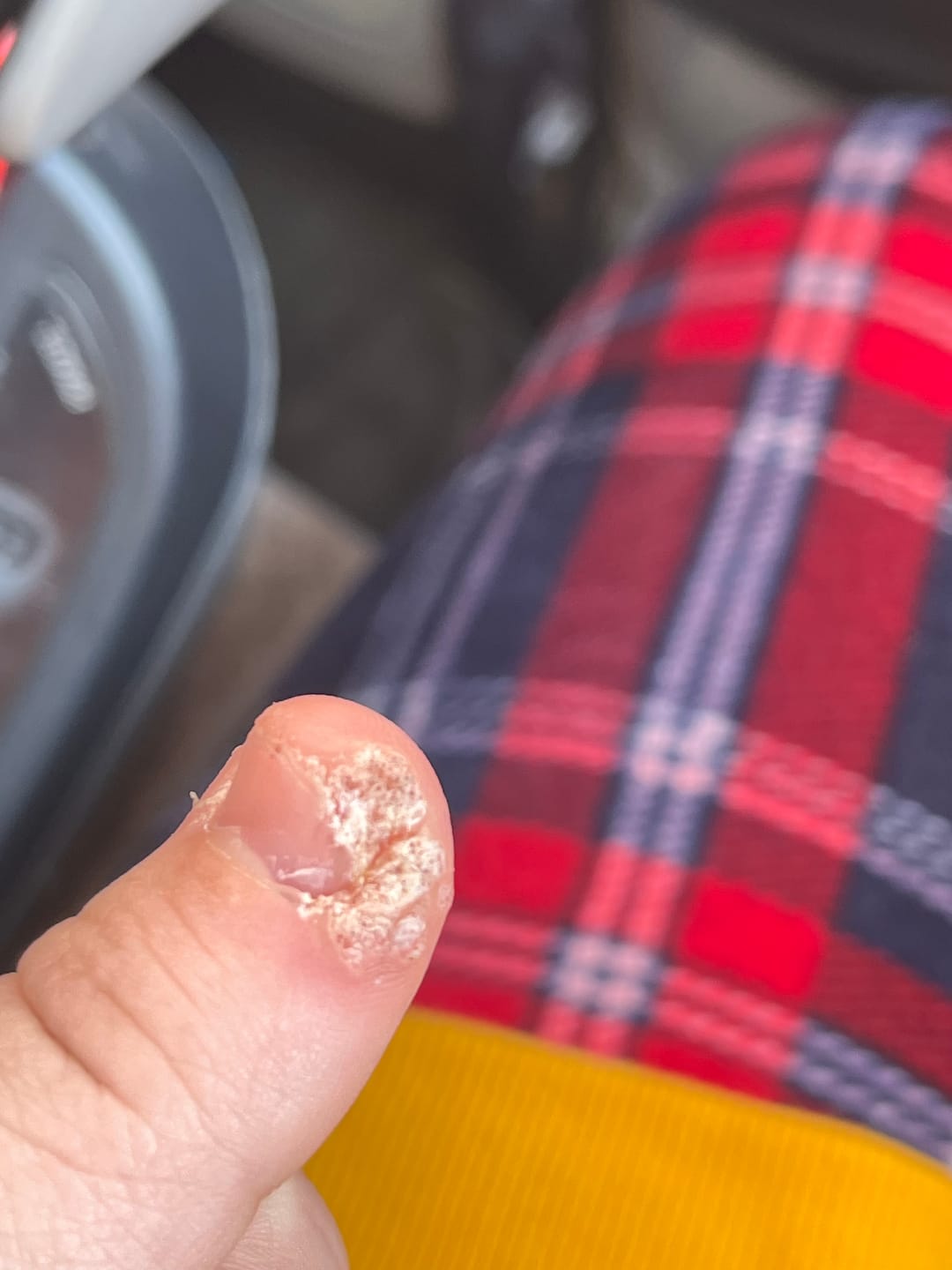 Customer photo review of The Wartabater | Electronic Wart Remover | Safe, Easy, & Effective