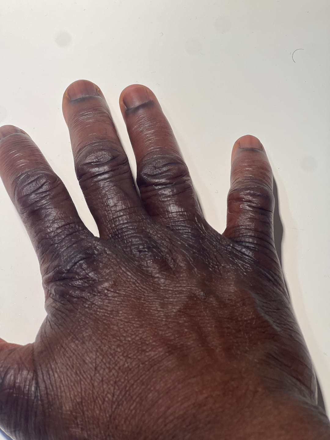 Customer photo review of Dark knuckle- Dark Spots Remover Serum