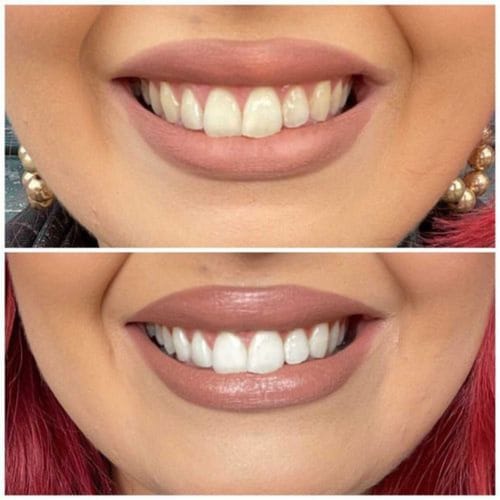 Customer photo review of Polar MD Teeth Whitening Kit
