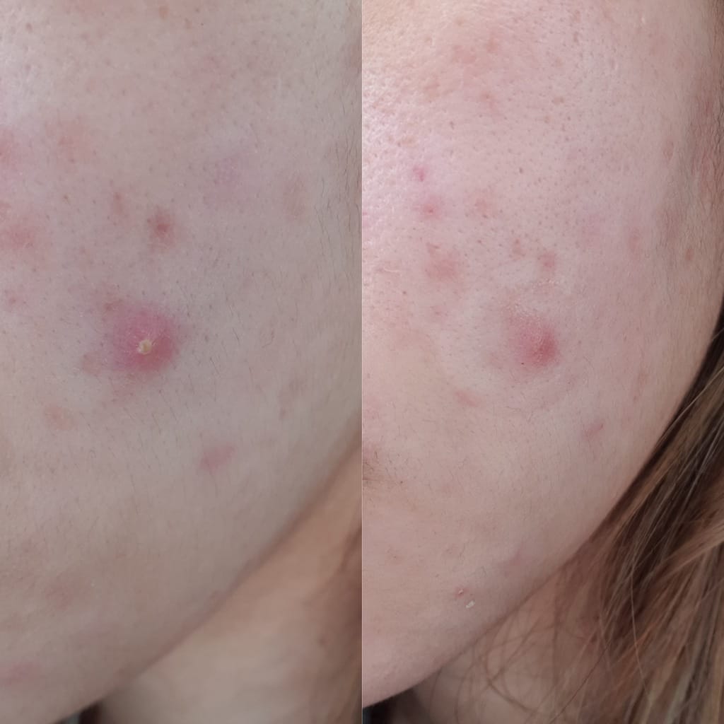 Customer photo review of Day & Night Acne Patches