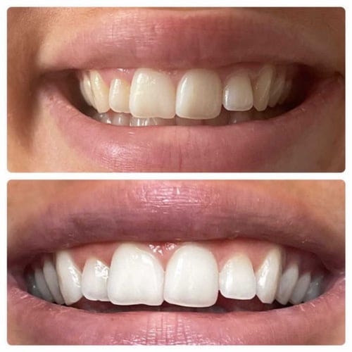 Customer photo review of Polar MD Teeth Whitening Kit