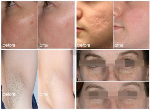 Customer photo review of DuoSmooth 2-in-1 Diode Laser + IPL System