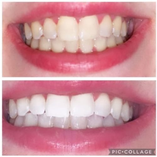 Customer photo review of Polar MD Teeth Whitening Kit