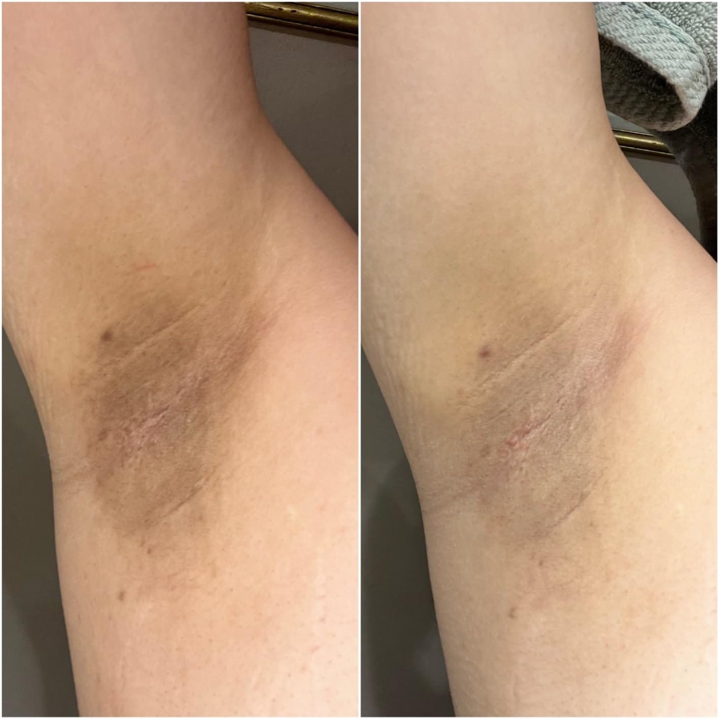Customer photo review of Intimate Lightening Cream