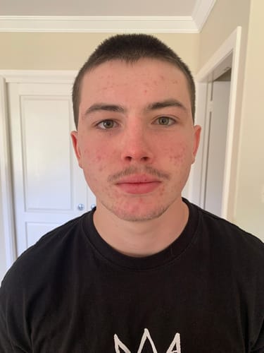 Customer photo review of Intermediate Acne Program™