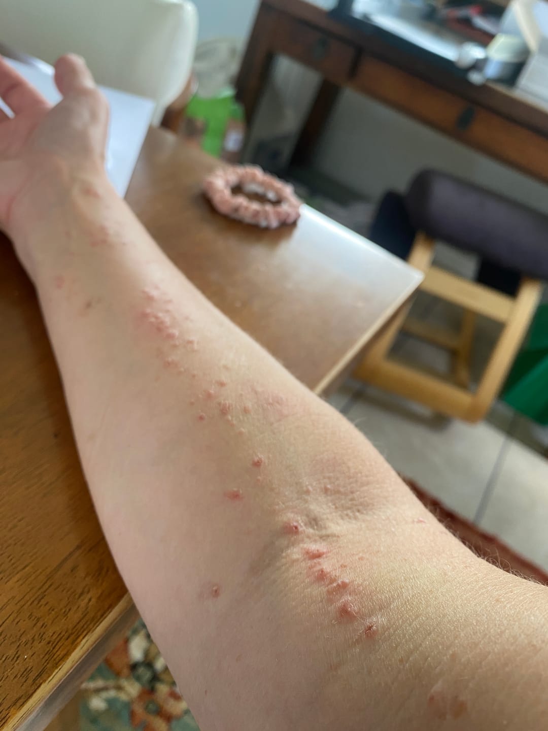 Customer photo review of The Wartabater | Electronic Wart Remover | Safe, Easy, & Effective
