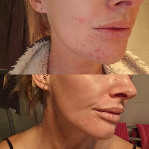 Customer photo review of Intermediate Acne Program™