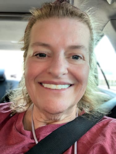 Customer photo review of Pop On Veneers with Impression Kit