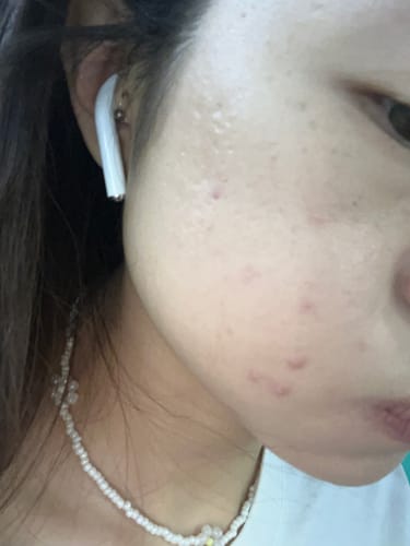 Customer photo review of Ulike超光炮美容儀-IG限時專屬優惠-PINKBOX