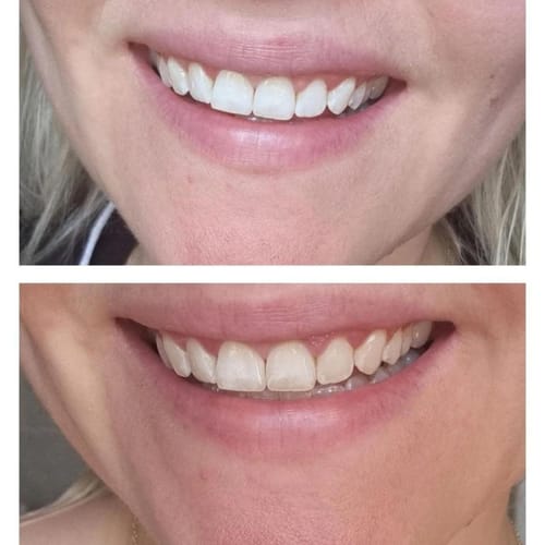 Customer photo review of משחה להלבנת שיניים - smilekit