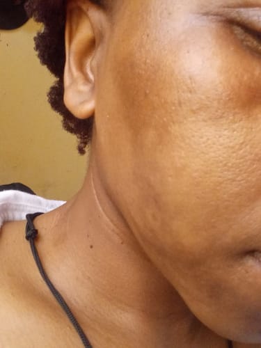 Customer photo review of HyperPigmentation, Acne & Bumps Set