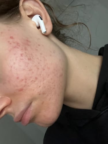 Customer photo review of Salicylsäure BHA 2% 50 ml