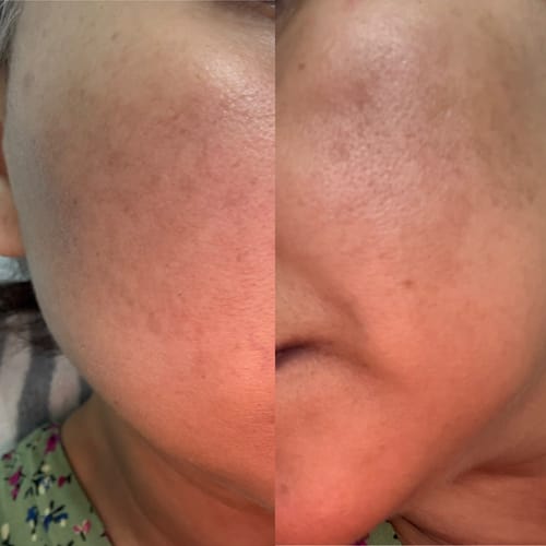 Customer photo review of Anti-Acne & Dark Spots African Soap